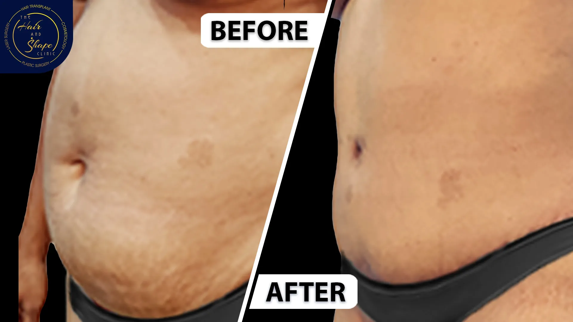 Tummy Tuck result3